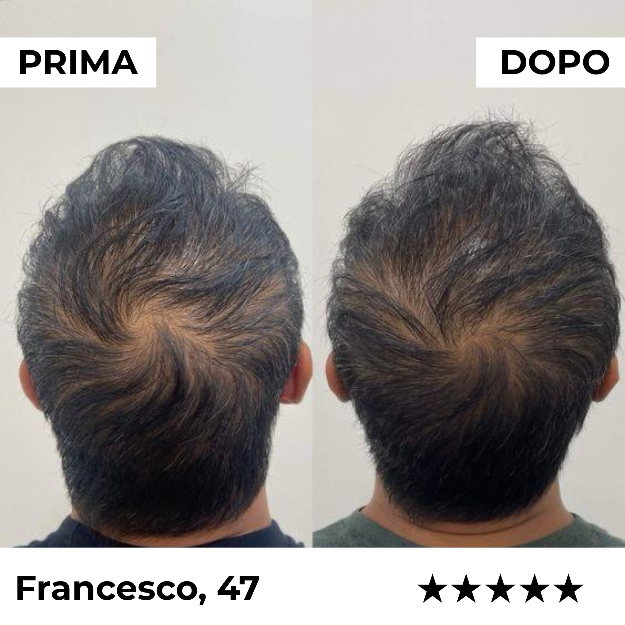 Sistema de microinfusión Firmelià® para el recrecimiento del cabello