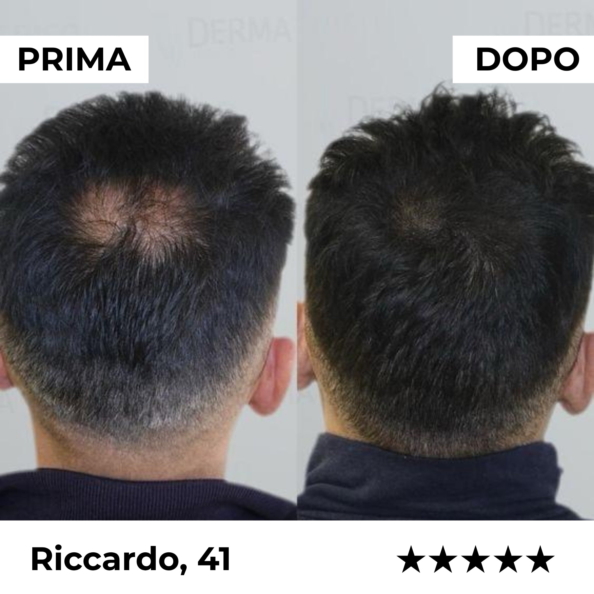 Sistema de microinfusión Firmelià® para el recrecimiento del cabello